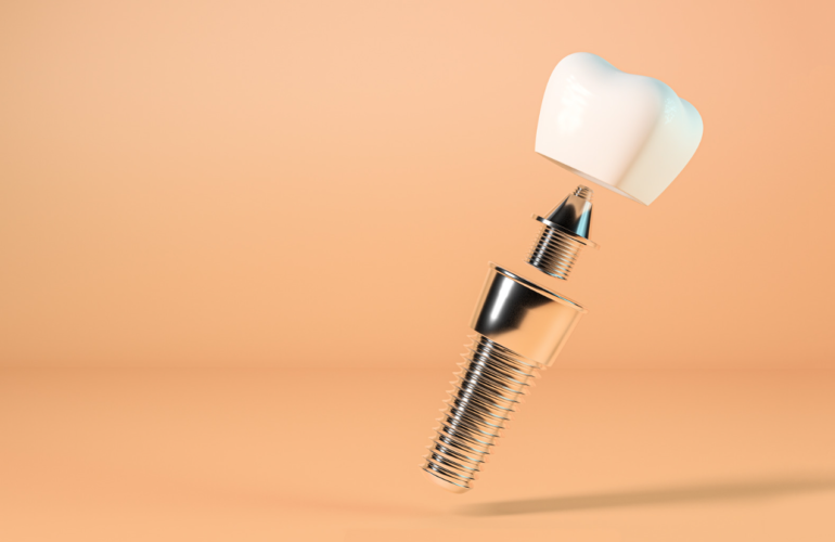 Dental Implants