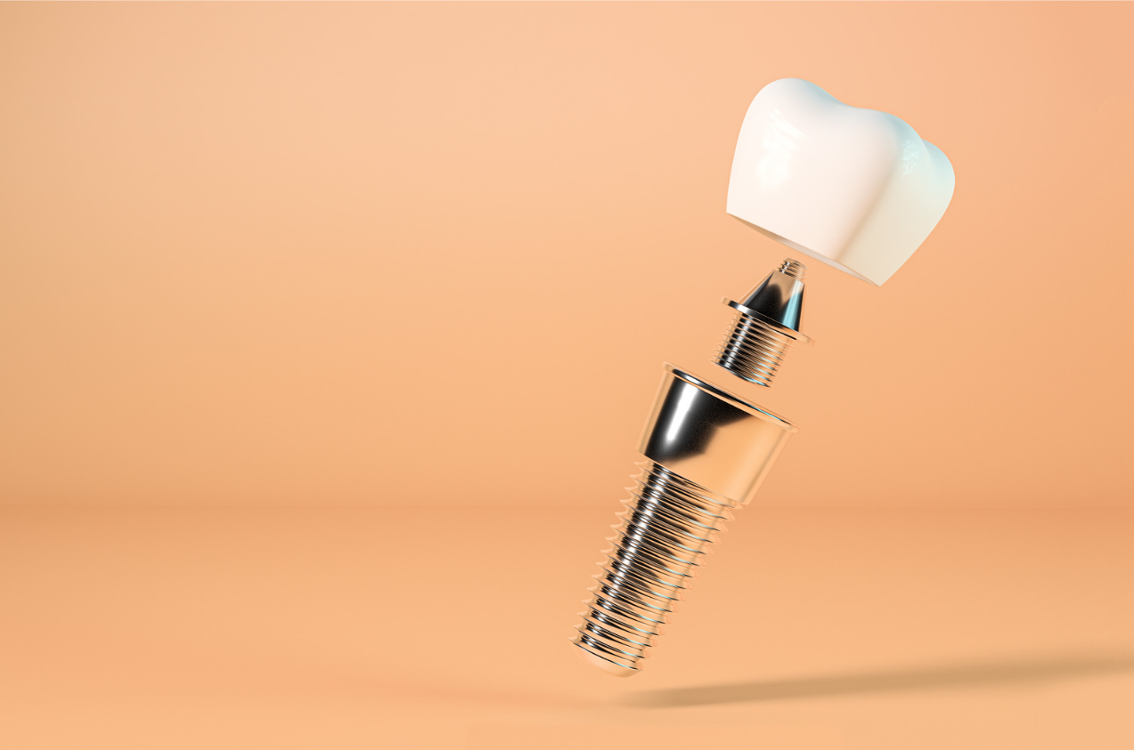 Dental Implants