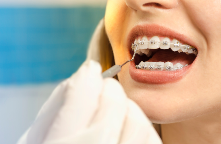 Dental Braces