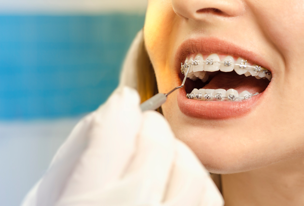 Metal Braces vs. Invisalign  Carrollton Smiles General Dentist