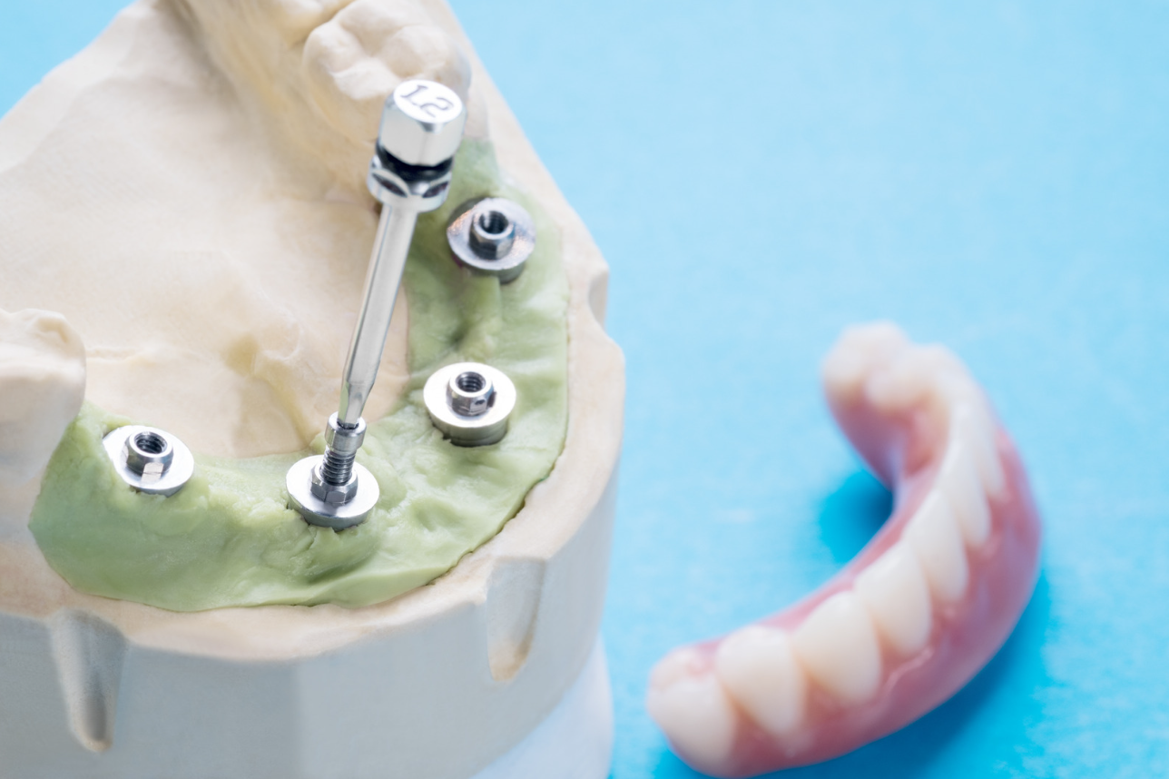 Full mouth dental implants