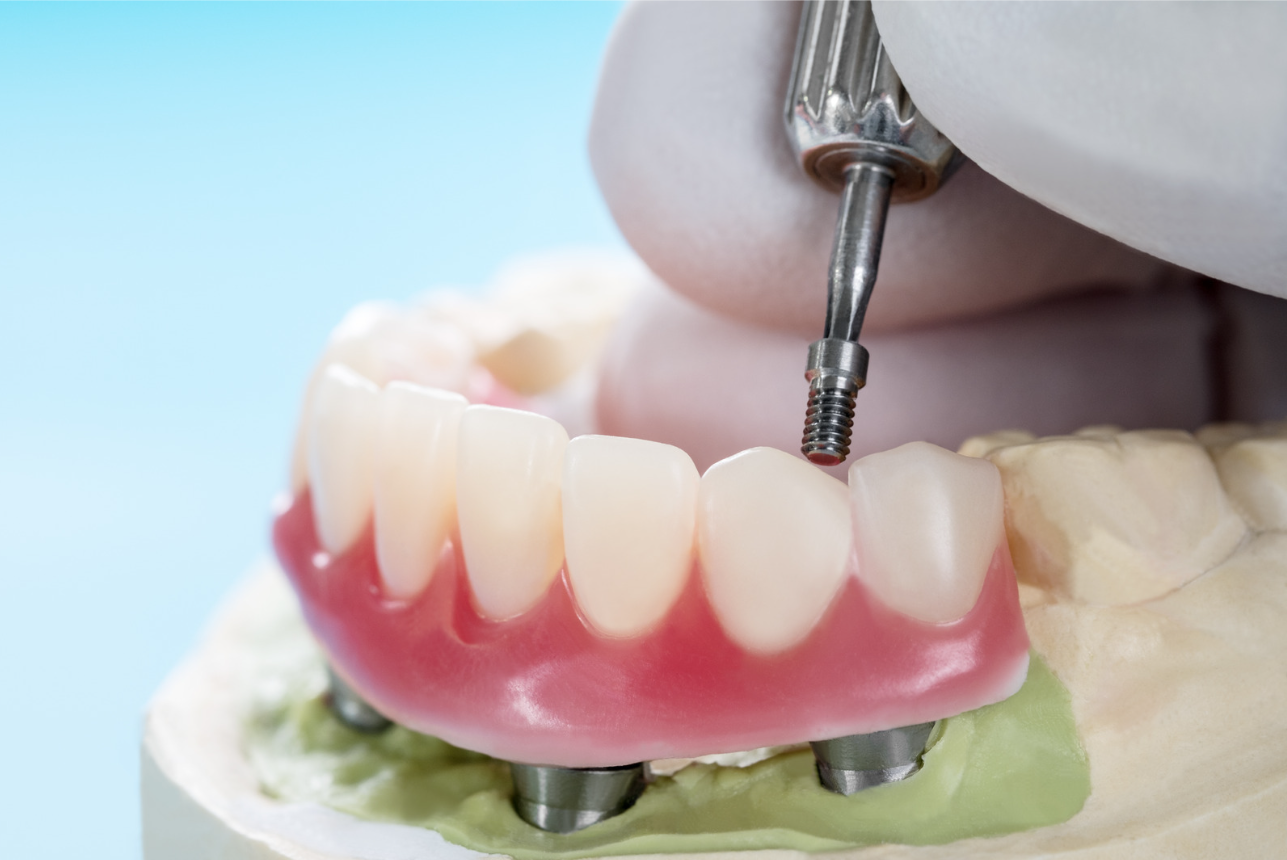 Dental implant surgery