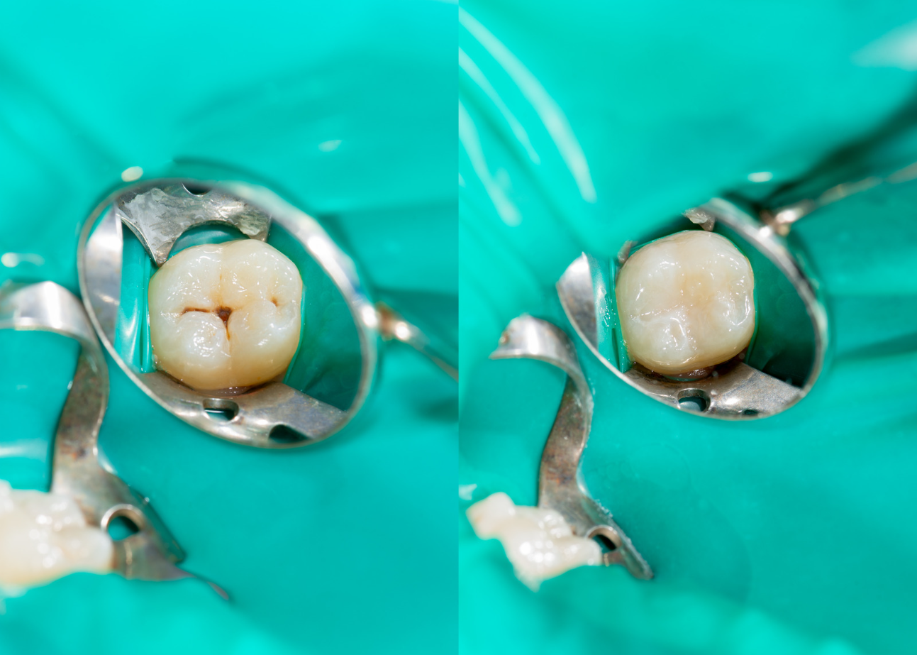 Root Canals Treatment