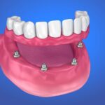 All on 4 dental implants